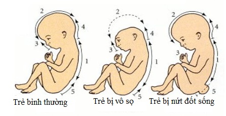 Hậu quả của thiếu hụt acid folic với phụ nữ mang thai 1
